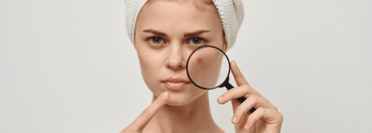 Hormonal Acne Treatment